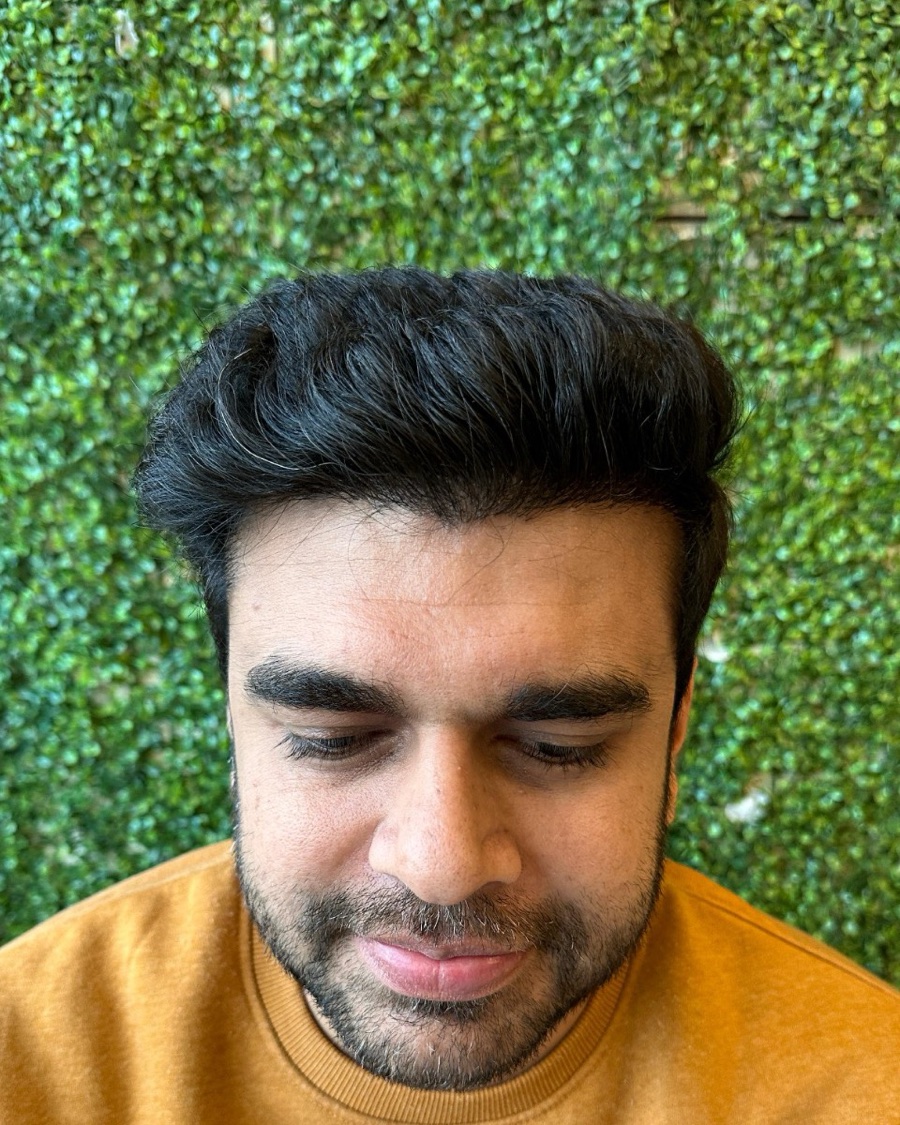 The same patient six months later with a fully grown-in hairline
