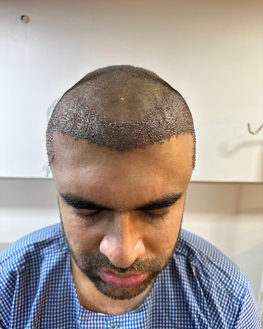 Hairline on the day of the procedure, 2,200 grafts just implanted