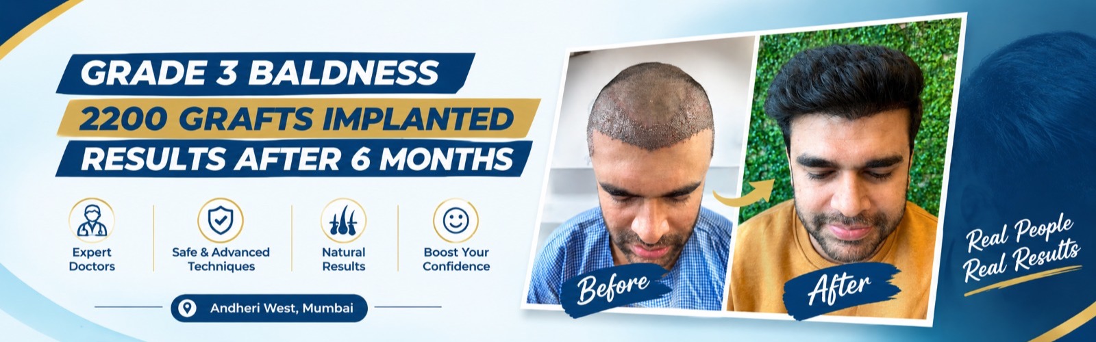 Grade 3 baldness, 2,200 grafts implanted, results after six months — before and after photographs